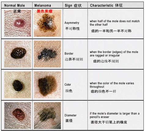 身上的痣|痣也可能会癌变！长在 3 个地方要注意